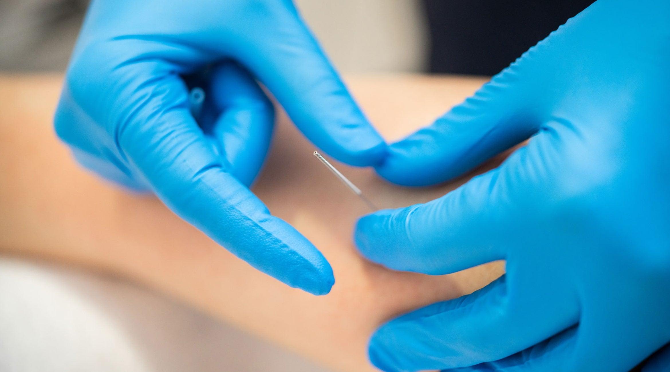 Does Dry Needling Work for Tennis Elbow? - Fiix Body